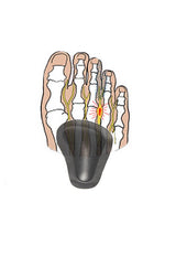 Self-adhesive pads for sunken forefoot arches