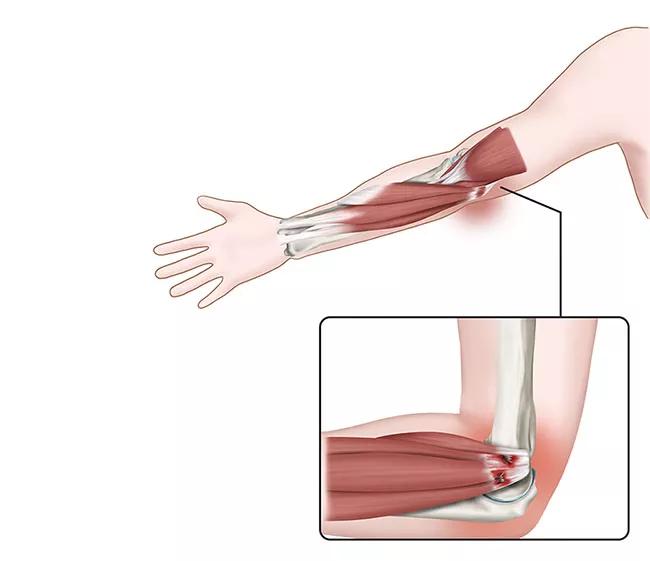 Bandage gegen Golfarm 